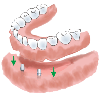 Cosmetic Dentures supported dental implants